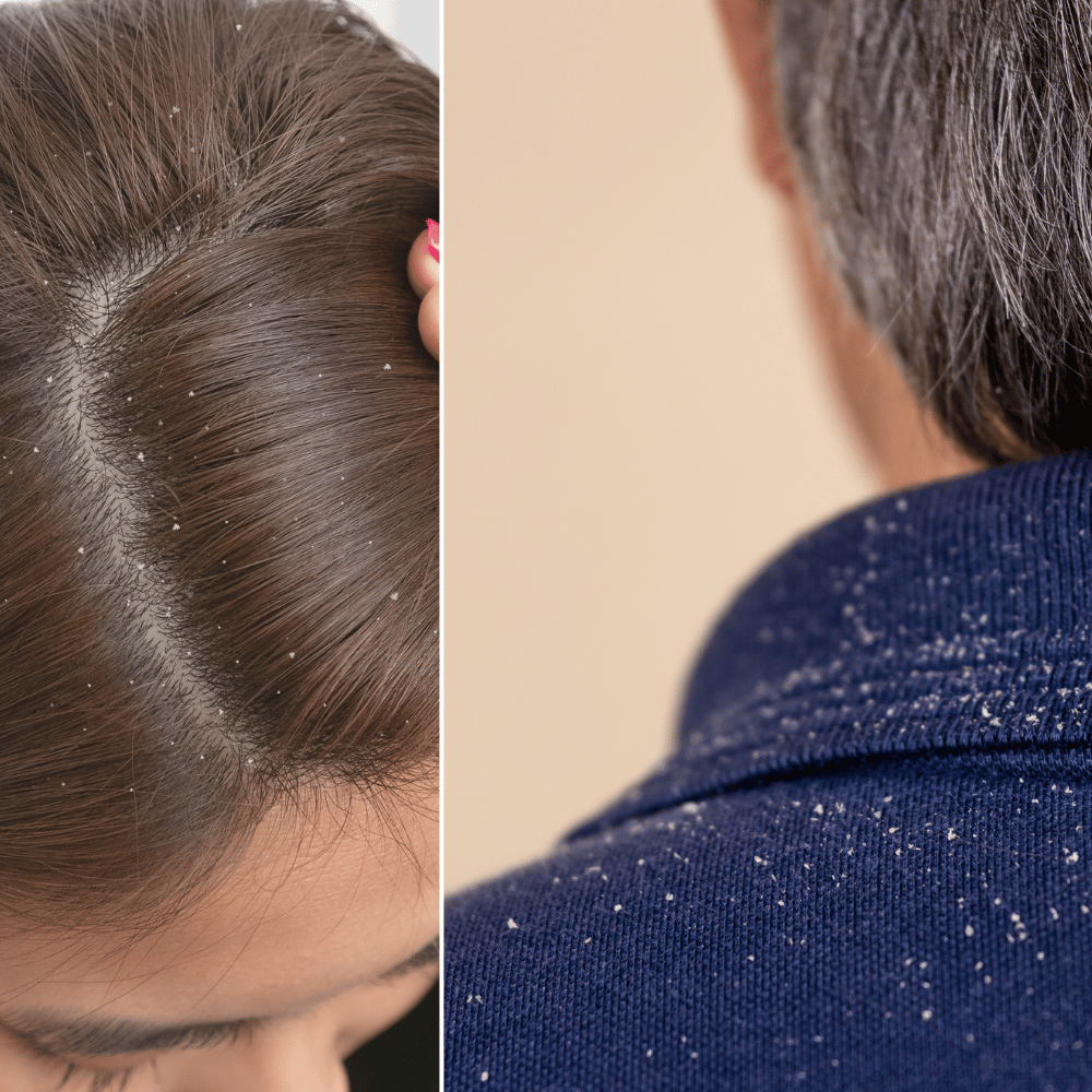 Top Rated 10 Best Shampoo For Dandruff In 2023