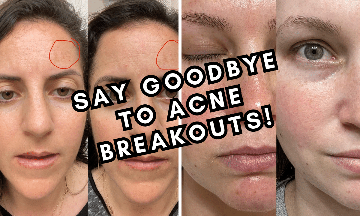 Put Your Best Face Forward Reviewing 5 Azelaic Acid Serums For